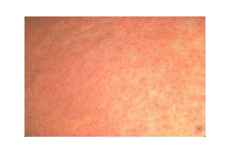Irritant Contact Dermatitis Armpit