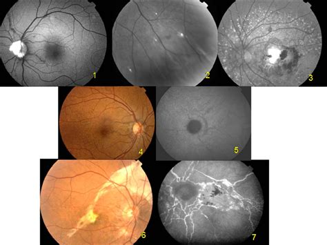 Retinal Features Of Pseudoxanthoma Elasticum 1 Angioids Streaks And