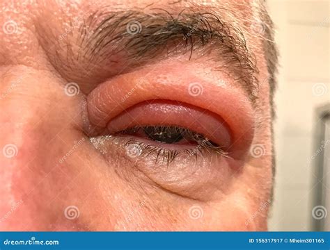 Sore Swollen Eyelid Offers Discount Save 44 Jlcatjgobmx