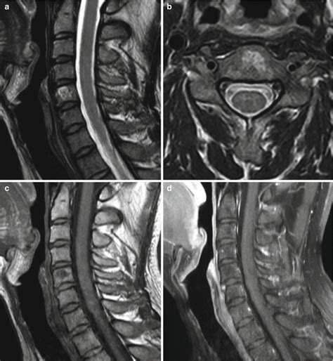 Common Spinal Tumors Outside The Top 3 Lists In Alphabetical Order Radiology Key
