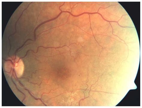 Fundus Photograph Of The Left Eye Showing A Tortuous Retinal Vein With