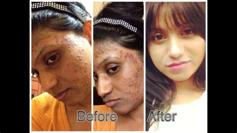 Diy How To Get Rid Of Acne Fast Home Remedy Acne Allergic