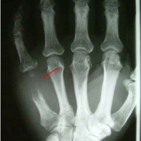 The Swelling At The Dorsal Part Of The Hand Over The 5th Metacarpal
