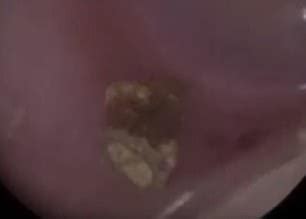 Stomach Churning Footage Shows A TWIG Being Pulled Out Of A Three Year Old Babe S Ear Daily
