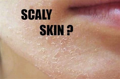 Signs And Symptoms About Scaly Skin Fitness Quotes