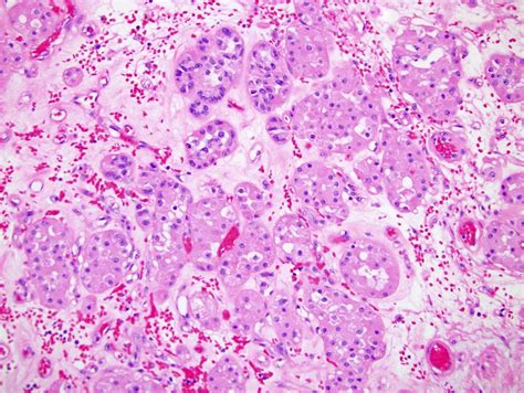 Pathology Outlines Oncocytoma