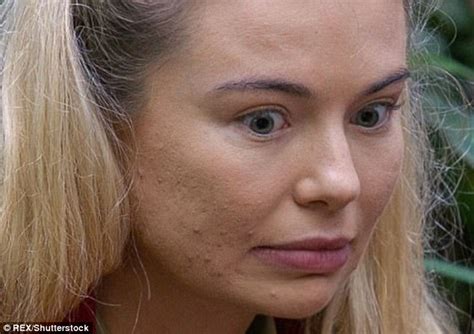 Im A Celebs Toff Reveals Acne Scarring On This Morning