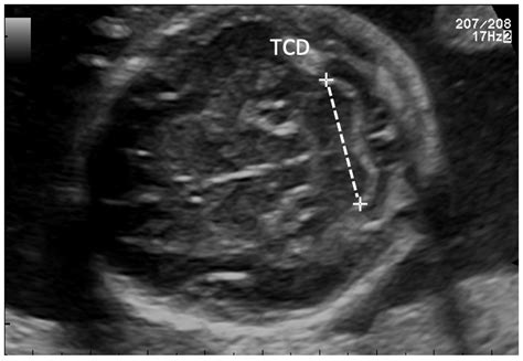 Common Biometry Parameters Transverse Section Of A Femur Length