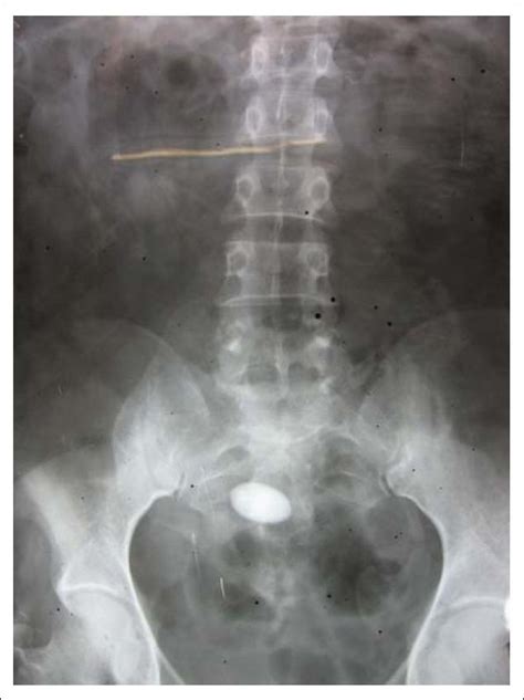 X Ray Photos Of Kidney Stones