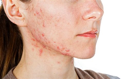 5 Facts About Adult Acne Page 2