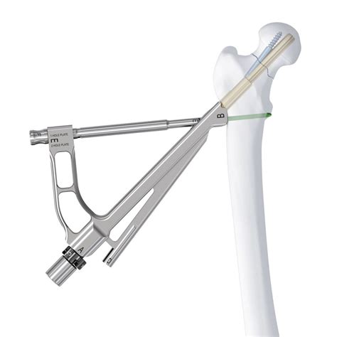 Depuy Synthes Launches Femoral Neck System Orthoworld
