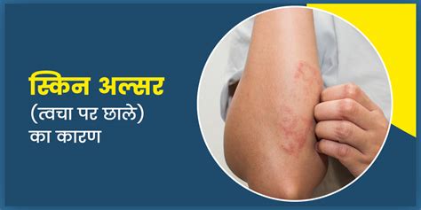 Skin Ulcers Causes Symptoms And Prevention Tips In Hindi