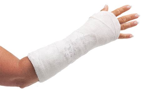 Arm Cast Stock Photos Pictures And Royalty Free Images Istock