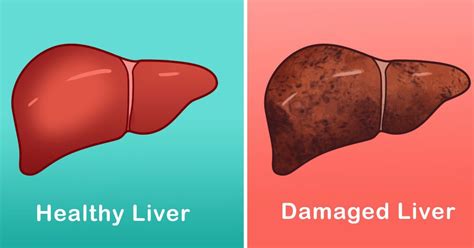 10 critical signs of liver disease | Liver disease, Liver, Liver failure