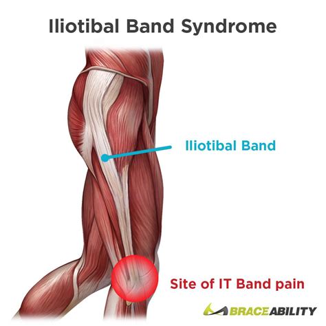 Iliotibial Band Syndrome Itbs It Band Syndrome It Band Iliotibial