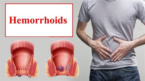 hemorrhoids what causes hemorrhoids and regular symptoms for this pile hemorrhoids what
