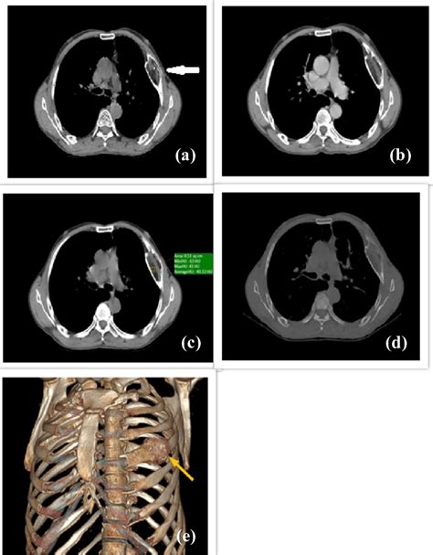 A Axial Plain Ct Chest Image Showed A Welldefined Expansile Lytic