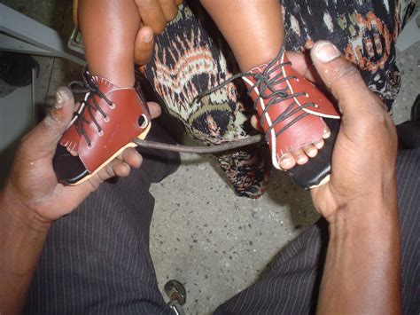 Clubfoot is twice as common in boys. Prosthetics and Orthotics Village: Club Foot deformity.
