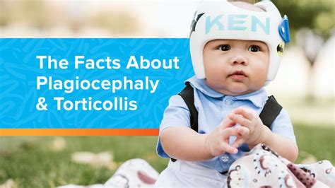 Hanger Clinic The Facts About Plagiocephaly And Torticollis