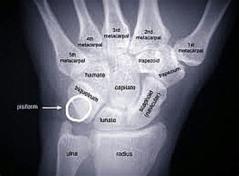 A Normal Wrist Xray Radiology Student Physical