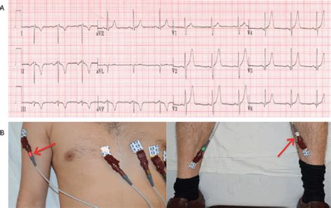 View Of Common Ecg Lead Placement Errors Part I Limb Lead Reversals