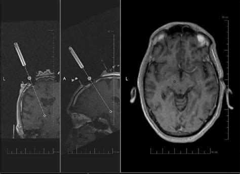 Interventional Magnetic Resonance Imaging Guided Subthalamic Nucleus