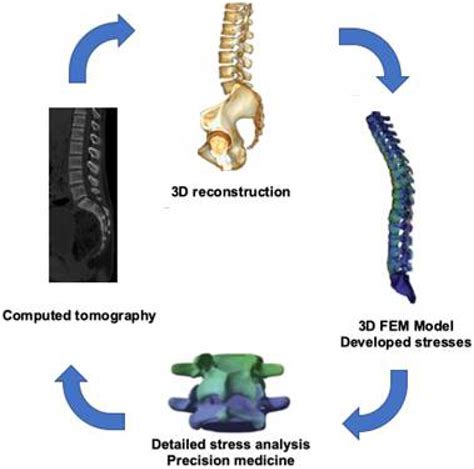 Medical Human Lumbar Disc Disease Presentation Model Orthopedic Spine