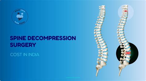 Best Spine Surgeons And Doctors From India Mozocare