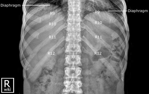 Ribs Radiographic Anatomy Wikiradiography Medical Radiography