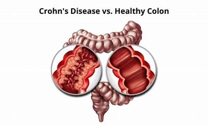 Disease Crohn Surgery Crohns Symptoms Procedures Colon