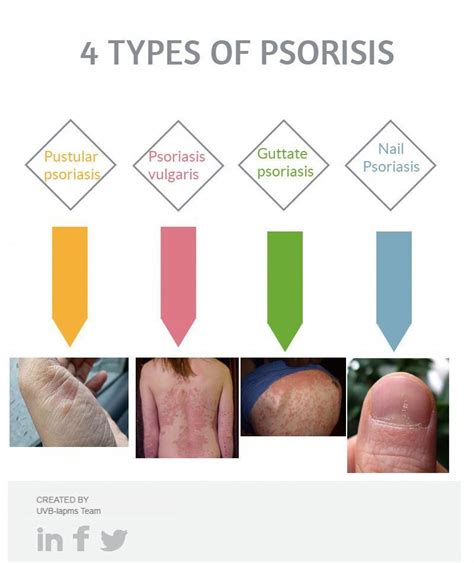 Does Guttate Psoriasis Go Away Rash Causes Stages Symptoms Treatment