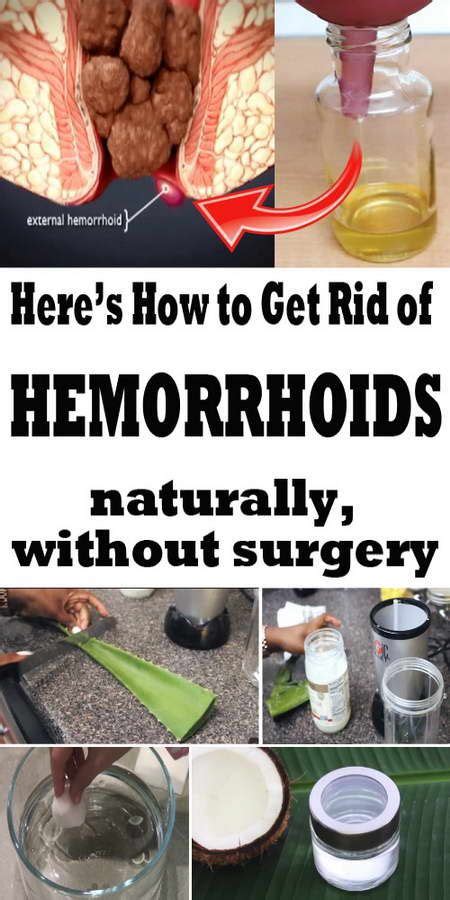 Get Rid Of Hemorrhoids Naturally Home Remedies For Hemorrhoids