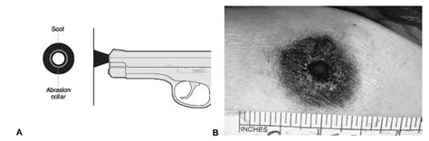 Evaluation Of Gunshot Wounds