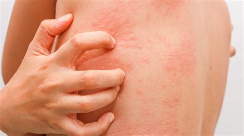 Zinc Deficiency Dermatology Conditions And Treatments