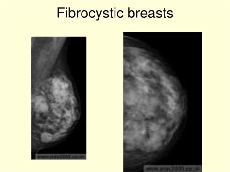 Ppt Mammography 2 Powerpoint Presentation Free Download Id 4110986