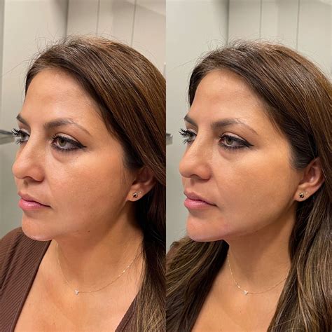 Jawline Contouring Vanessa Injects