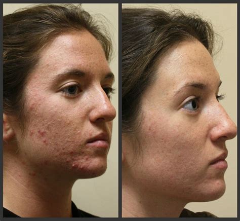 Isolaz And Fraxel Acne Laser Treatments Before And After Yelp