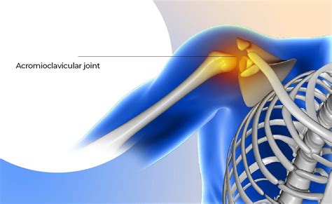 Acromioclavicular Joint Pain Curezone Physiotherapy