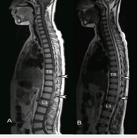 Mri Whole Spine Sagittal View A T Weighted And B T Weighted