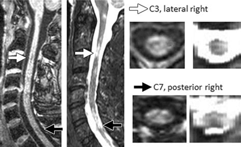 Cervical Cord T1 Weighted Hypointense Lesions At Mr Imaging In Multiple