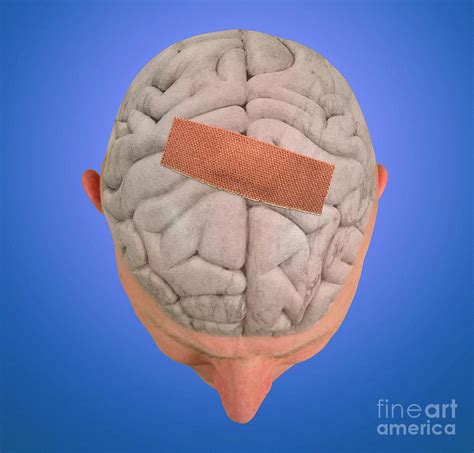 Brain Damage Photograph By Victor De Schwanbergscience Photo Library