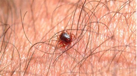 Pictures Of Lyme Disease Rashes Pictures Photos