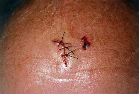 A sutured scalp laceration - Stock Image - M330/0267 - Science Photo ...