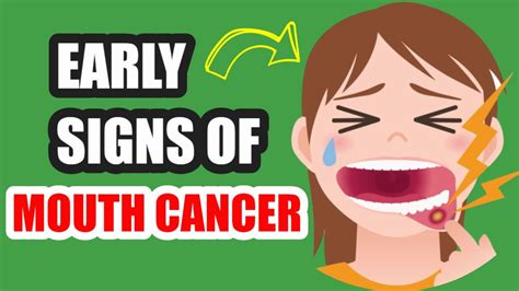 10 Early Signs Of Mouth Cancer You Should Not Ignore Youtube