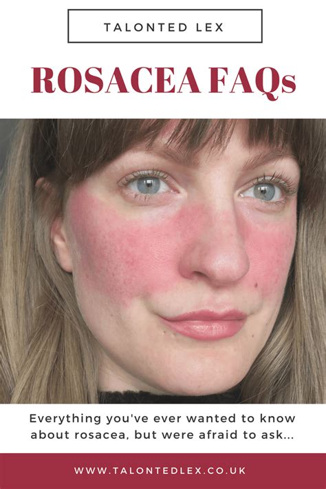 Pin On Rosacea Skin Care