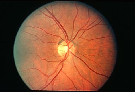 Superior Crescent Optic Nerve Retina Image Bank