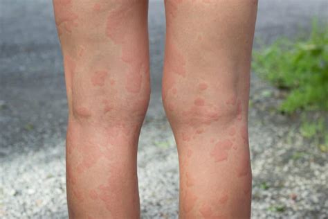 What Are Hives Mcgovern Allergy And Asthma Clinic