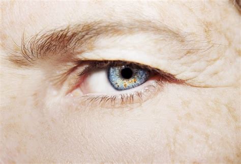 Baggy Eyelids Dermatochalasis Symptoms And Treatment Grosinger