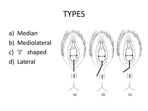 Episiotomy