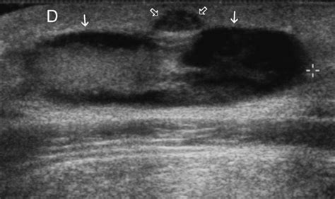 Epidermal Cysts In The Superficial Soft Tissue Huang 2011 Journal
